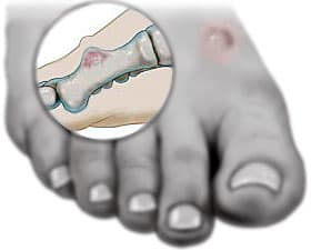 Ganglion Cyst