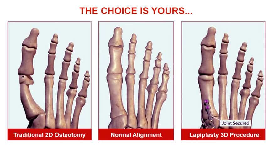 lapiplasty-choice