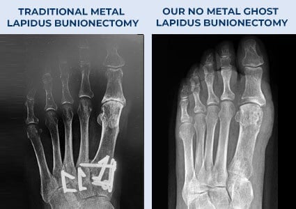 Ghost lapidus bunionectomy, no metal bunion surgery before and after