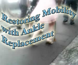 Ankle-replacement-restores-mobility