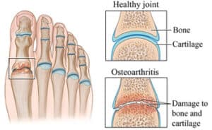 OA-big-toe-arthritis-1