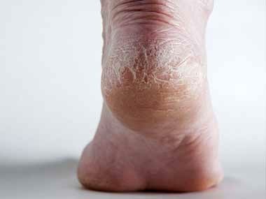 RD-Dry-Flaky-Feet