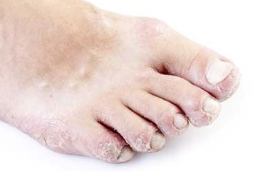RD-Pitted-ToeNails-2