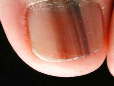 RD-Straight-Line-Under-Nail