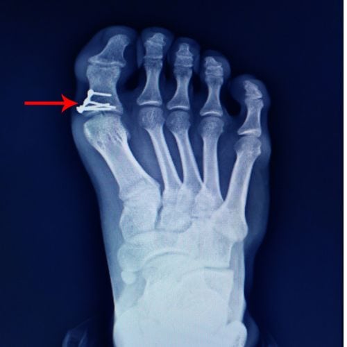 X-ray image showing a fractured toe with surgical pins for fixation, highlighting the importance of expert foot and ankle surgery in Los Angeles.