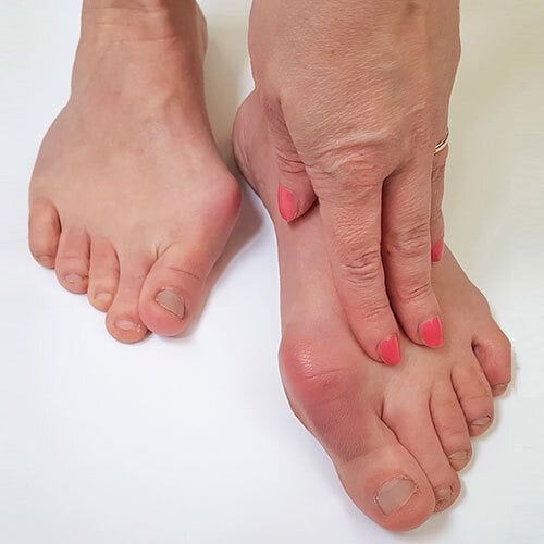Lady feet with Bunions